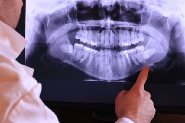 Best Emergency Wisdom Teeth Removal in Carbon Hill, AL