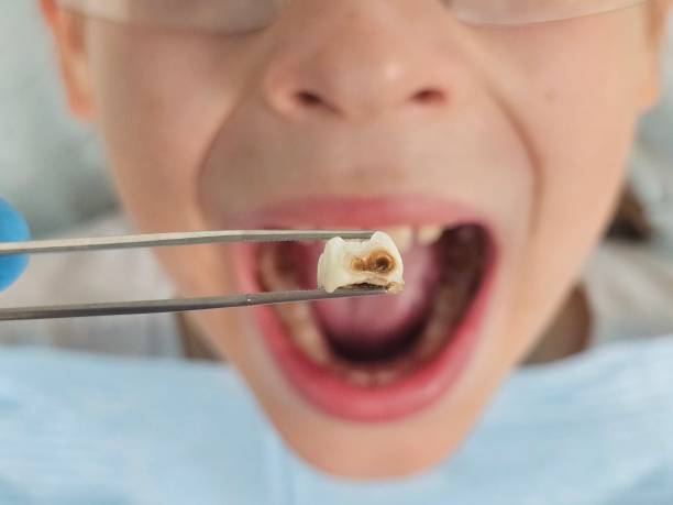 Best Emergency Tooth Extraction in Carbon Hill, AL